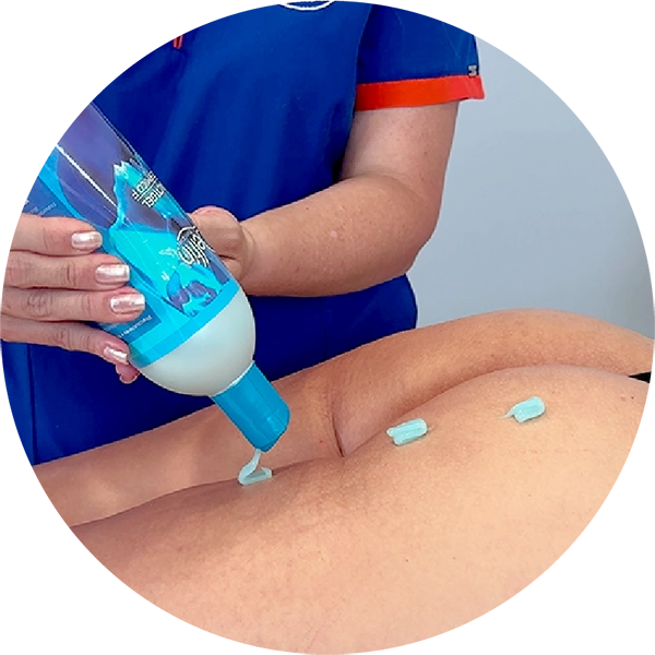 Gel criogenico