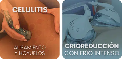 Tratamientos 2 ES